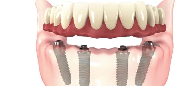 allOn4-implant-img