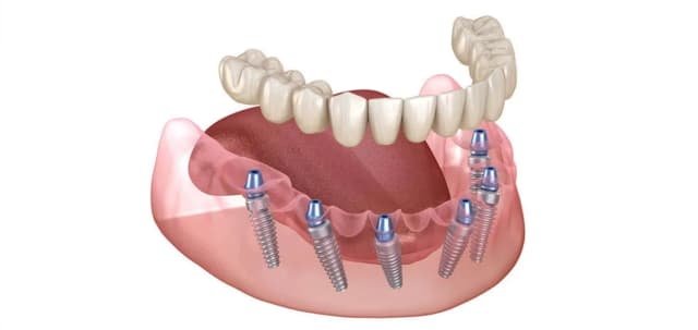 allOn6-implant-img